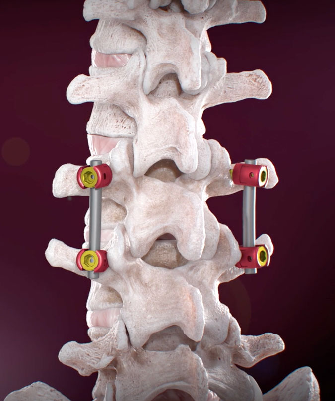 A 3D rendered image of Lumbar Pedicle Screw Placement during Spine Stabilization.