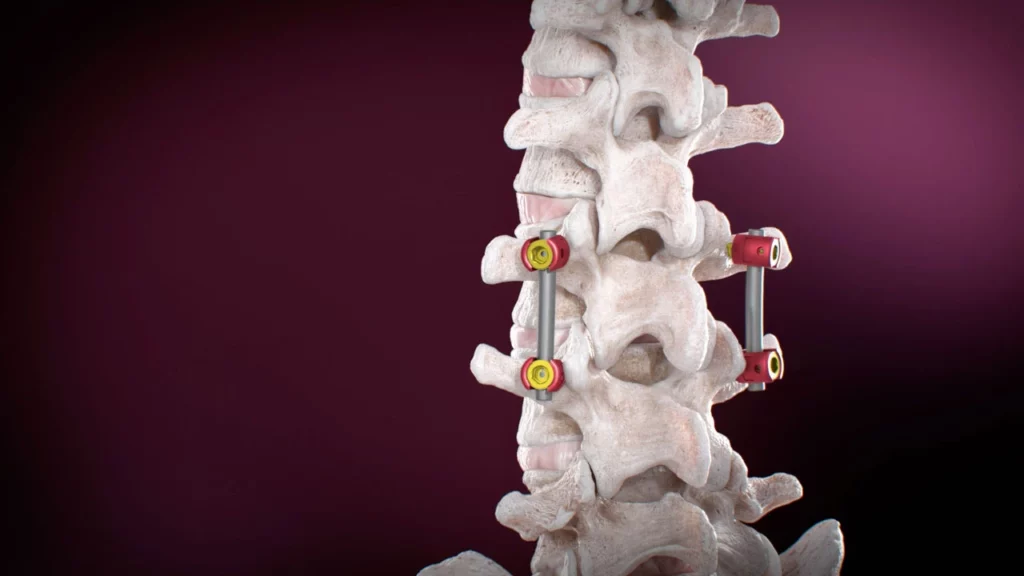 lumbar pedicle screw placement