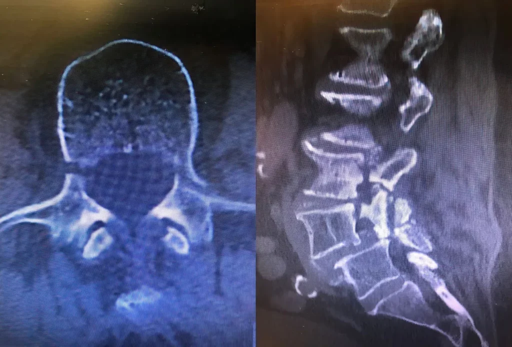 Fracture of Pedicle X-ray Axial and Lateral View comparison side by side