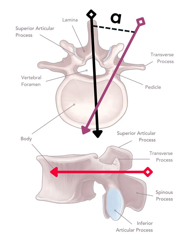 Basic pedicle screw planning visualized. Axial, Lateral and Superior view of a spine disc. Includes a black line from the spinous process to the anterior vertebral body, bisecting the spine. A purple line is shown from the base of the lateral superior articular facet through the thickest part of the pedicle. These lines are intended to help calculate the axial angle (α) formed by these two lines - which is visualized mathematically.