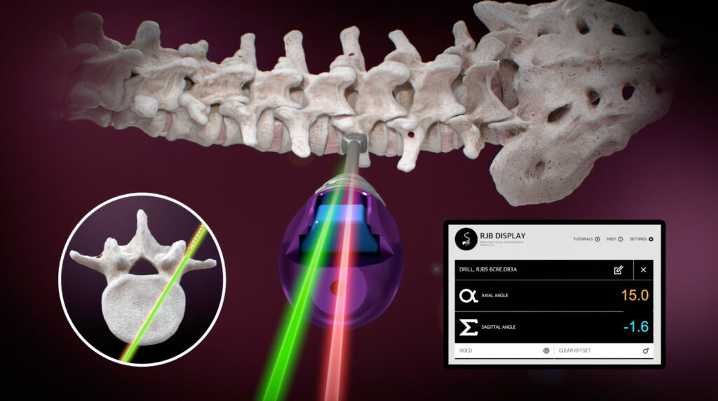 The Ruthless Spine RJB intraoperative surgical angle measurement tool, for instance, offers real-time visualization of the axial and sagittal trajectory of the instrument shaft, ensuring precise screw placement​​​​.