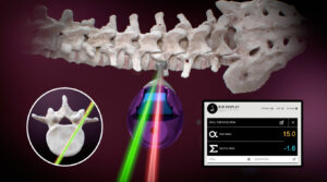 RJB Ruthless Spine’s Intraoperative Surgical Angle Measurement Tool