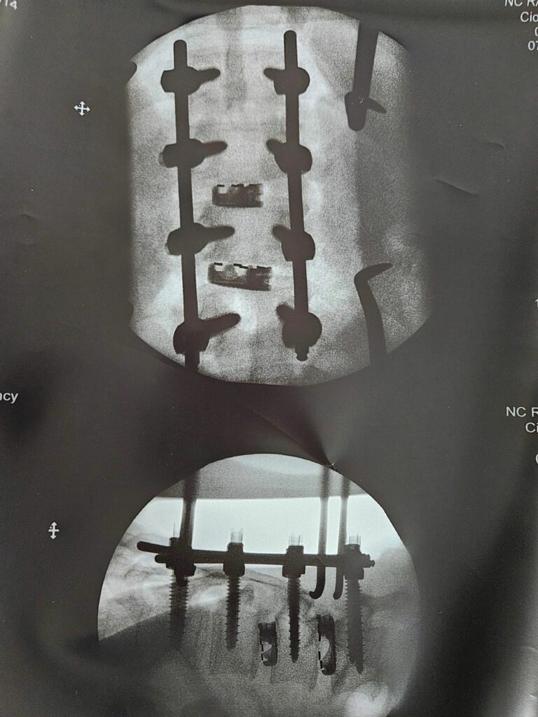 lumbosacral pedicle screw implantation