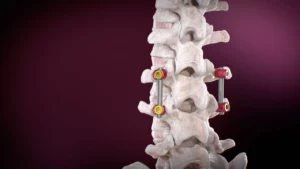 lumbar pedicle screw placement