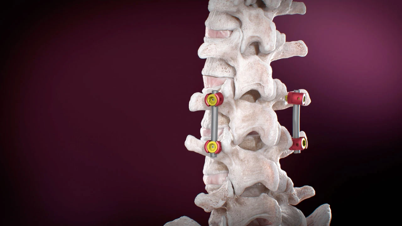 Lumbar Pedicle Screw Placement: How to Enhance Spine Stabilization