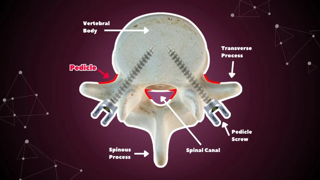 A superior view of a spinal disk, with arrows pointing out the anatomy. Vertebral Pedicles are highlighted in red.