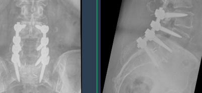 Axial T2 MRI images show the axial angles for pedicle screw insertion at the L3 levels