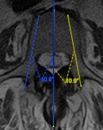 pedicle screw insertion at the L3 levels